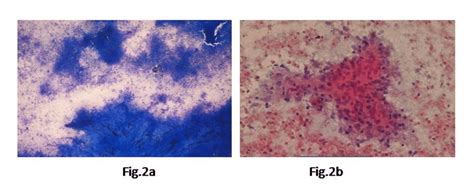 a: Micro photographs showing extensive caseation necrosis and ...