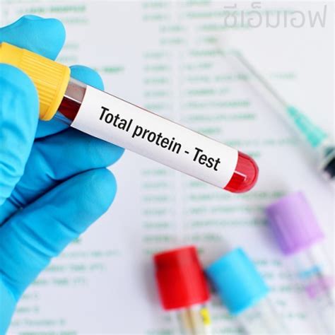 Total Protein (Albumin, Globulin, A:G) Test 1S - Pharma Xonline