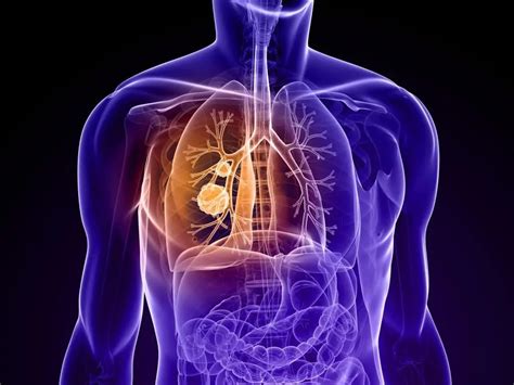 Non-small cell lung cancer: causes, diagnosis, stages of the disease, treatment and prognosis ...
