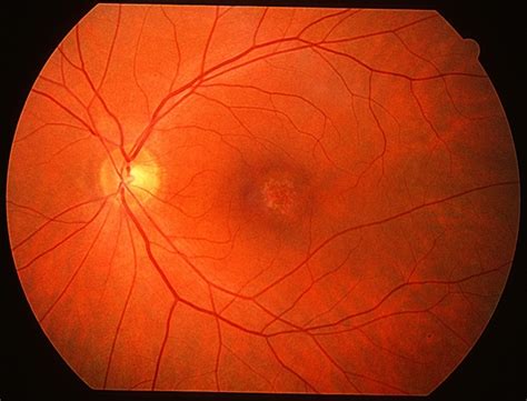 Cone Dystrophy - Retina Image Bank