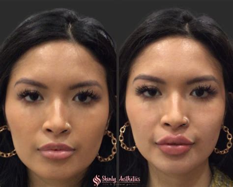 Russian Lip Filler: NYC's Top Choice for Fuller, Heart-Shaped Lips