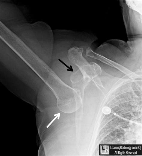 Luxatio Erecta (Inferior Dislocation). The humeral head (white arrow) lies below (inferior) to ...