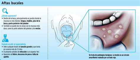 Aftas: las molestas úlceras de la boca