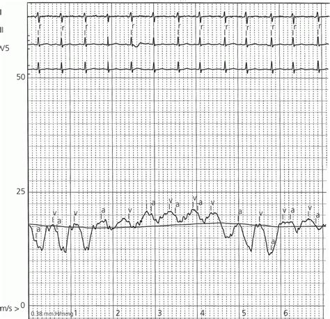 5: The atrial waveform | Thoracic Key