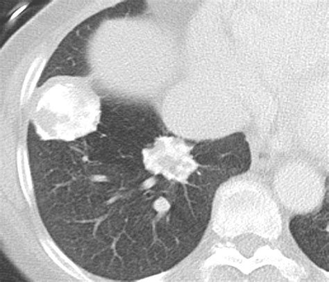 Noninfectious Granulomatous Diseases of the Chest | RadioGraphics