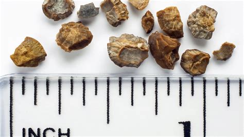 More Southerners at risk for kidney stones