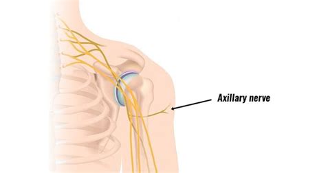 Axillary Nerve Injury - Symptoms, Causes and Treatment