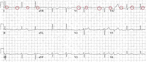 ECG of the Week: ECG of the Week - 19th October 2015 - Interpretation