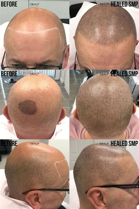 AMAZING RESULT | Scalp Micropigmentation (SMP) Before and After | Birmingham UK