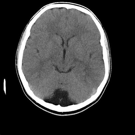 Mega Cisterna Magna Vs Arachnoid Cyst