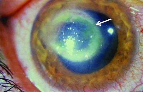 Acanthamoeba keratitis causes, signs, symptoms, diagnosis, treatment & prognosis