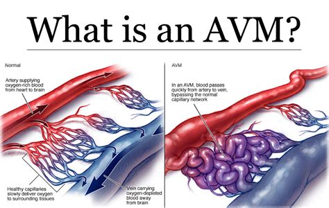 Arteriovenous Malformation - Brain Avm - Causes, Symptoms, Treatment