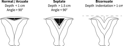 Uterine septum: a guideline - Fertility and Sterility