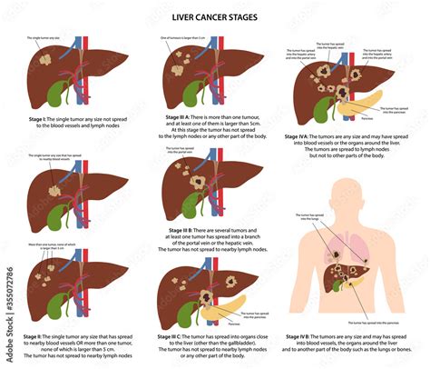 Four stages of liver cancer with description corresponding steps of ...