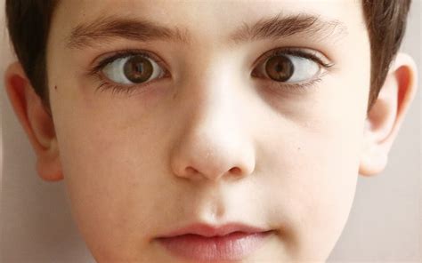 Tracking the elusive genes that cause strabismus - Boston Children's ...