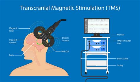 Transcranial Magnetic Stimulation therapy Orange County, CA