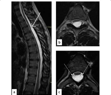 MRI of the arachnoid cyst in dorsal spine T2W sagittal (a) and axial ...