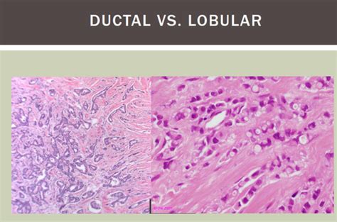 Invasive Ductal Carcinoma Histology