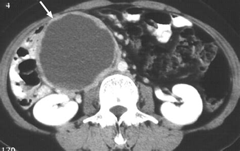 Retroperitoneal Cystic Masses: CT, Clinical, and Pathologic Findings ...