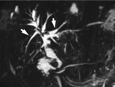 Cholangitis | Radiology Key