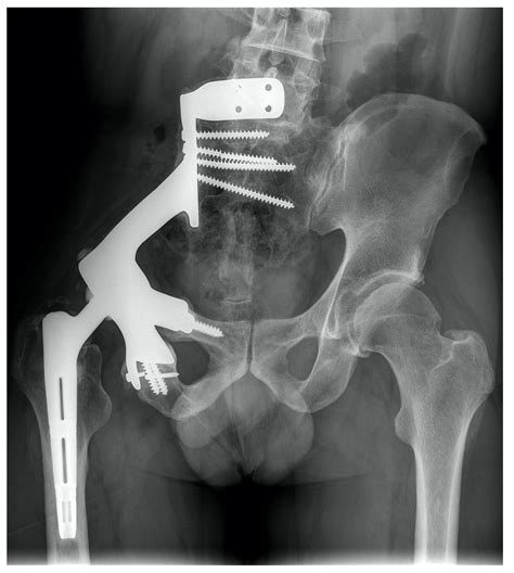 JPM | Free Full-Text | Patient-Specific Implants for Pelvic Tumor Resections