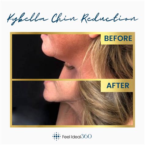 KYBELLA DOUBLE CHIN REDUCTION B&A - Feel Ideal 360 Med Spa - Southlake, TX