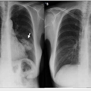 X-ray showing typical plain radiographic findings of aspergilloma A:... | Download Scientific ...