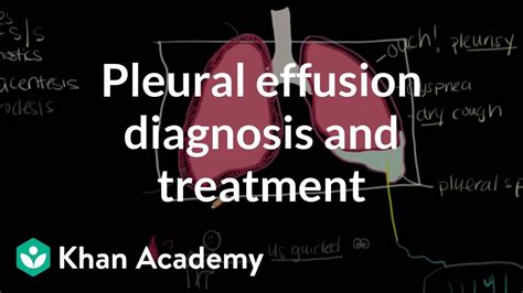 Pleural effusion diagnosis and treatment | Respiratory ... | Doovi