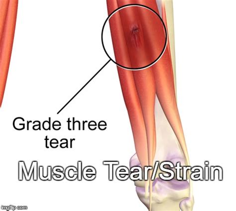 What is a muscle tear, strain or pull? | Motion Physiotherapy and ...