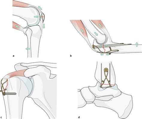 3.2.3 Tension band principle | Musculoskeletal Key