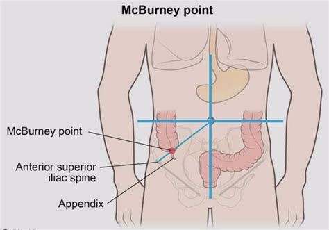 Pointing Sign In Acute Appendicitis / Muscular rigidity and tenderness ...