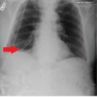 (PDF) Hemothorax Following Traumatic Dobhoff Tube Insertion