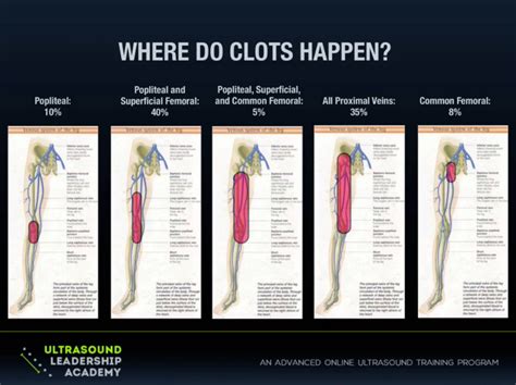 Image result for DVT ultrasound images | Ultrasound, Ultrasound technician, Post thrombotic syndrome