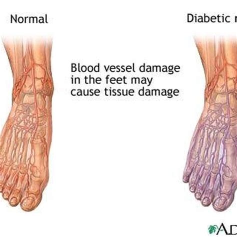 Reasons for Poor Circulation in the Feet | Healthy Living