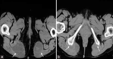 Ischiogluteal bursitis: A not to be forgotten differential of gluteal lesions with fluid-fluid ...