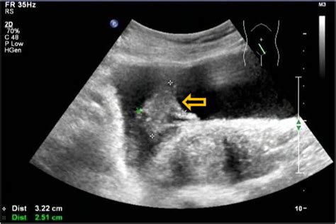 Conventional transabdominal ultrasound. A hyperechoic blood clot in the ...