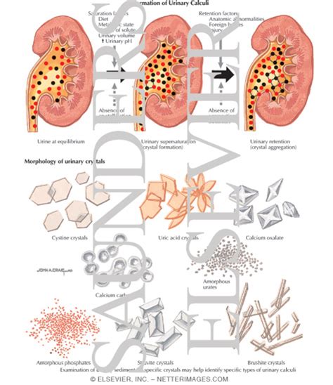 Formation of Urinary Calculi