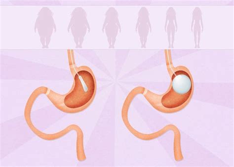 An Introductory Guide to Gastric Balloon Surgery | Balloons, Surgery, Strict diet