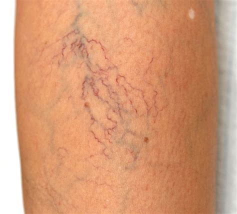 Vein Doctor Chicago – Varicose Vein Doctor & Spider Vein Doctor Chicago