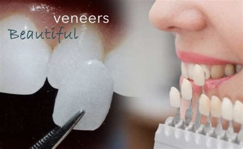 Cheaper Alternatives to Dental Veneers