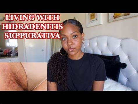 LIVING WITH HIDRADENITIS SUPPURATIVA (ACNE INVERSA) FOR 10 YEARS: MY ...