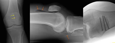 Compound patellar fracture - Radiology at St. Vincent's University Hospital