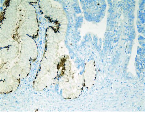 -A case of mucinous borderline tumor associated with carcinoma in situ ...