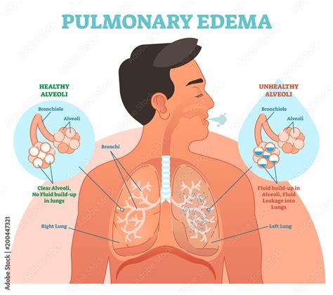 Edema Pulmonar Diagrama De Ilustraci N De Vectores Pulmonares Edema | The Best Porn Website