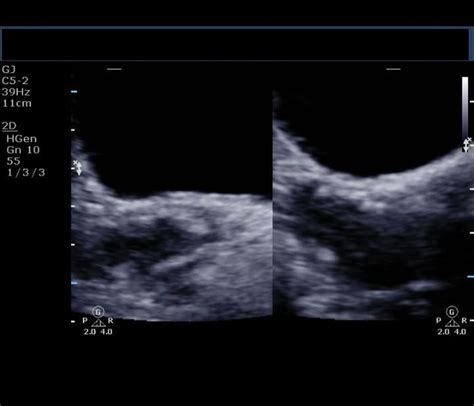 A Gallery of High-Resolution, Ultrasound, Color Doppler & 3D Images - Uterus