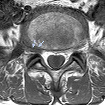 MRI nerve visualization informs surgery | FieldStrength | Philips