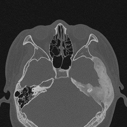 Fibrous dysplasia (FD) is a non-neoplastic tumor-like congenital ...