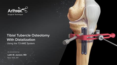 Arthrex - Osteotomy