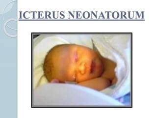 Physiological jaundice among newborns/ Icterus neonatorum | PPT