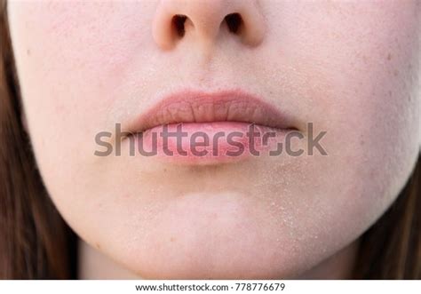 Girl Charred Skin On Face Around Stock Photo 778776679 | Shutterstock